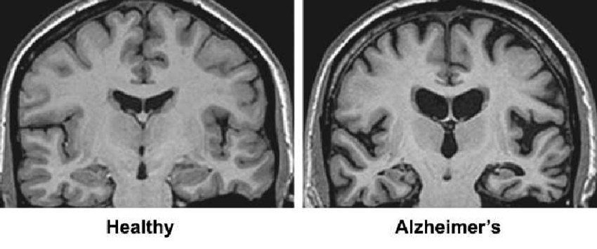 Yeni Çalışma, Alzheimer Hastalığı ile İlgili Önceki Fikirlere Meydan Okudu